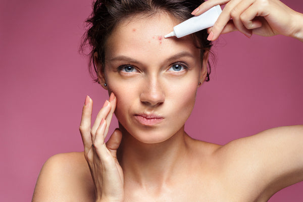 Optimizing Your Skincare for Acne-Prone Skin