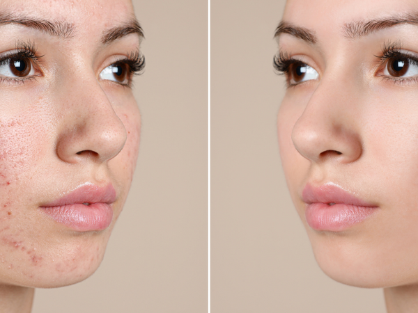 5 Ways MD GLAM Helps Your Acne Scars: Rejuvenating and Restorative Skincare System