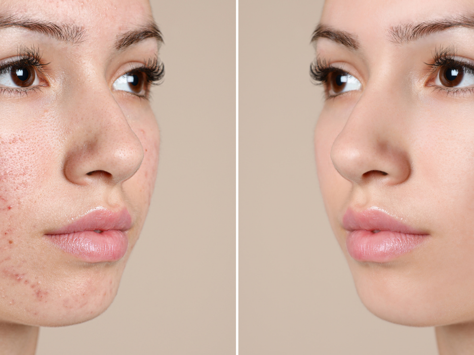 5 Ways MD GLAM Helps Your Acne Scars: Rejuvenating and Restorative Skincare System