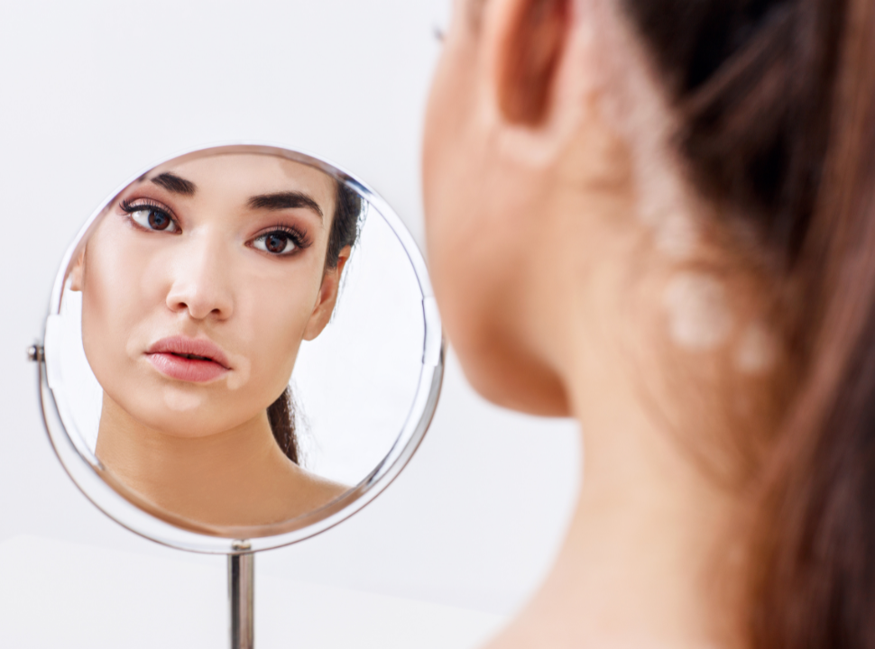 Understanding White Spots on Skin: Causes and Treatment